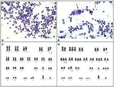 Case report: Therapy-related myeloid neoplasms in three pediatric cases with medulloblastoma